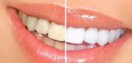 teeth whitening devonshire House